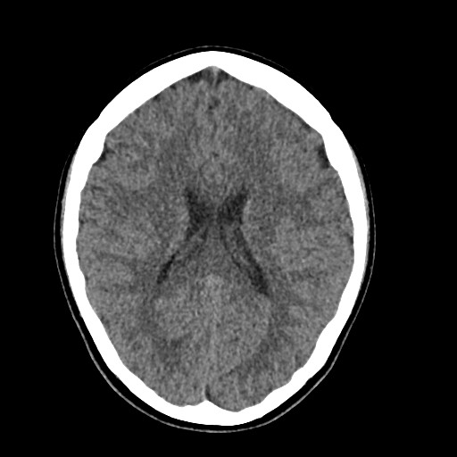 Cerebral cavernous venous malformation (Radiopaedia 70008-80022 Axial non-contrast 31).jpg