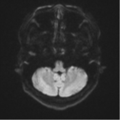Cerebral cavernous venous malformations (Radiopaedia 48117-52946 Axial DWI 33).png