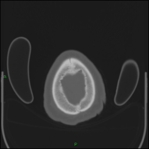 File:Cerebral contusions (Radiopaedia 33868-35039 Axial bone window 213).jpg