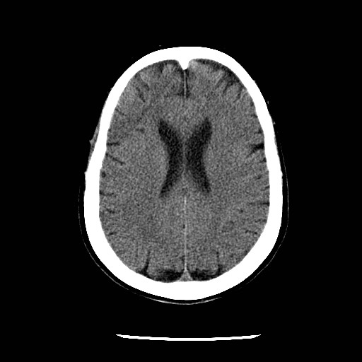 File:Cerebral edema (evolution in time) (Radiopaedia 19418-19441 non-contrast 64).jpg