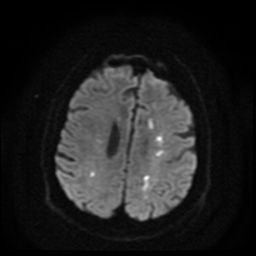 File:Cerebral embolic infarcts (embolic shower) (Radiopaedia 49837-55108 Axial DWI 63).jpg