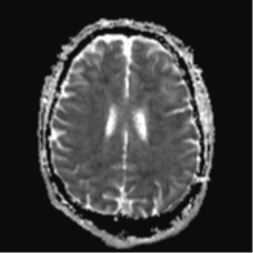 File:Cerebral embolic infarcts (embolic shower) (Radiopaedia 57395-64342 Axial ADC 24).png