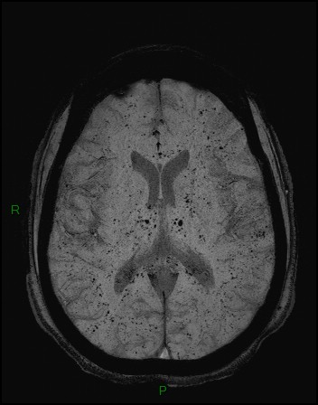 Cerebral fat embolism (Radiopaedia 35022-36525 Axial SWI 23).jpg