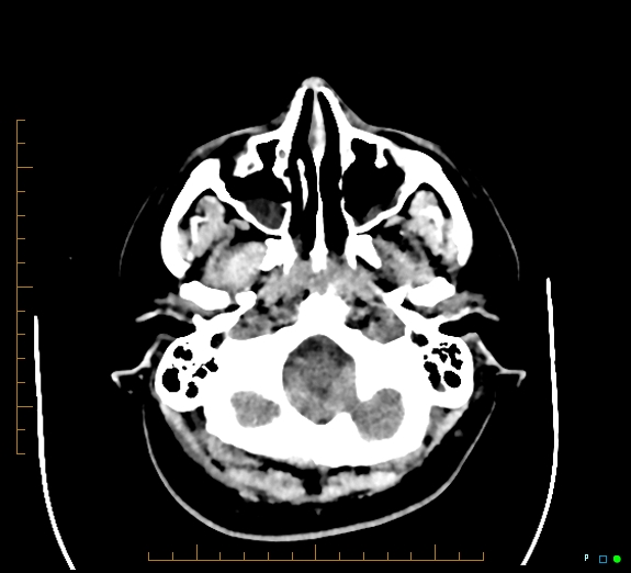 File:Cerebral fat embolism (Radiopaedia 85521-101220 Axial non-contrast 14).jpg