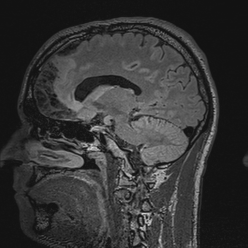 File:Cerebral hemorrhagic contusions- temporal evolution (Radiopaedia 40224-42757 Sagittal T1 47).png