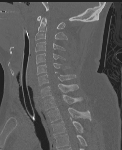 Cerebral hemorrhagic contusions and cervical spine fractures (Radiopaedia 32865-33841 Sagittal bone window 50).jpg