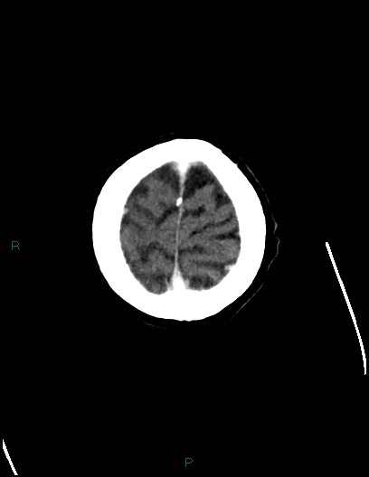 File:Cerebral metastases - ependymal and parenchymal (Radiopaedia 79877-93131 Axial C+ delayed 78).jpg