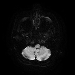 Cerebral metastases - melanoma (Radiopaedia 80972-94522 Axial DWI 39).jpg