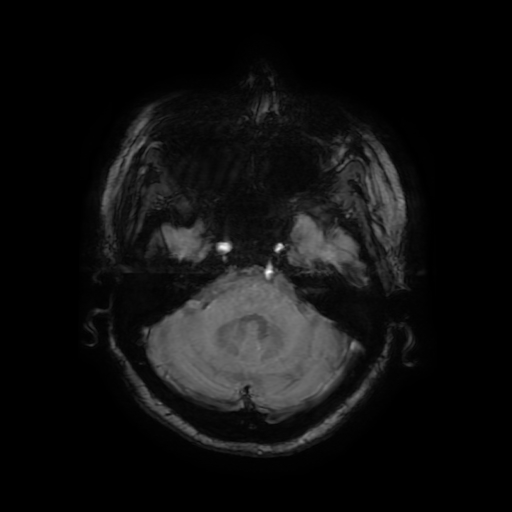 Cerebral metastases - melanoma (Radiopaedia 80972-94522 Axial SWI 25).jpg