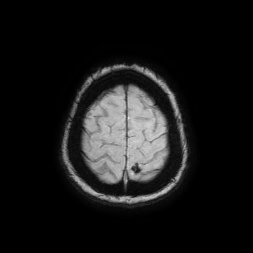 File:Cerebral metastases - melanoma (Radiopaedia 80972-94522 Axial SWI 88).jpg