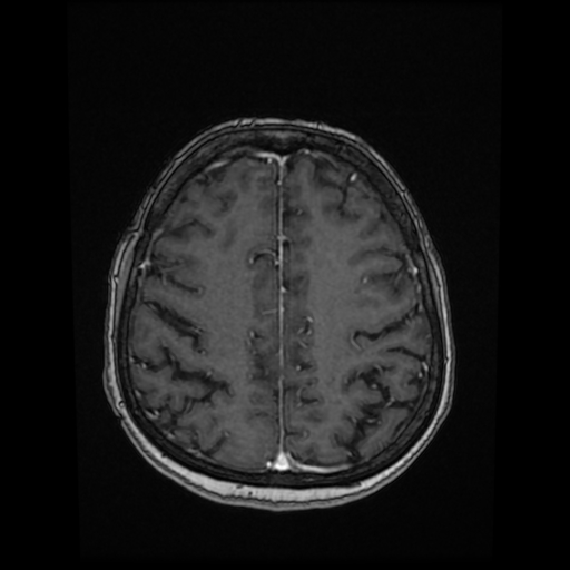 Cerebral metastases - melanoma (Radiopaedia 80972-94522 Axial T1 C+ 70).jpg