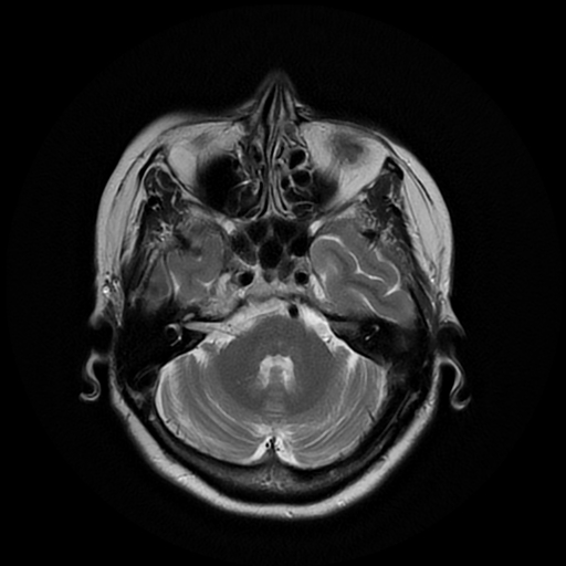 File:Cerebral metastases - melanoma (Radiopaedia 80972-94522 Axial T2 9).jpg