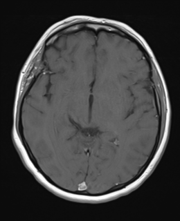 File:Cerebral metastases mimicking abscesses (Radiopaedia 45841-50131 Axial T1 C+ fat sat 14).png