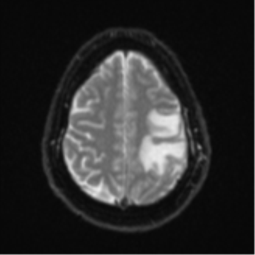 Cerebral metastases mimicking multifocal glioblastoma (Radiopaedia 50843-56353 Axial DWI 21).png