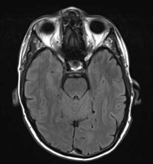 File:Cerebral metastasis - melanoma (Radiopaedia 54718-60954 Axial FLAIR 11).png