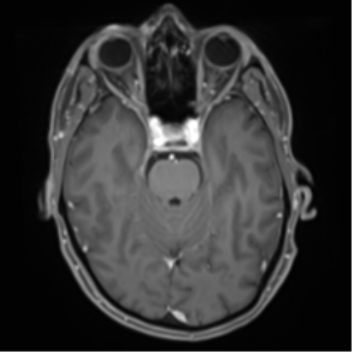Cerebral metastasis - melanoma (Radiopaedia 54718-60954 Axial T1 C+ fat sat 19).png