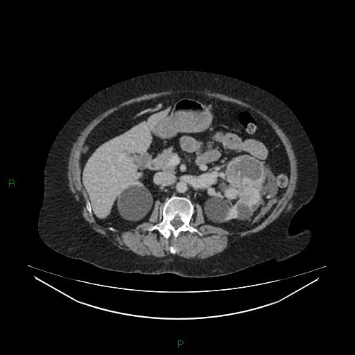 Cerebral metastasis from renal cell carcinoma (Radiopaedia 82306-96378 A 68).jpg