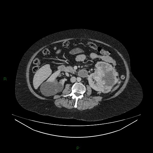 Cerebral metastasis from renal cell carcinoma (Radiopaedia 82306-96378 A 87).jpg