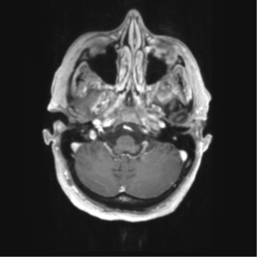 Cerebral metastasis mimicking glioblastoma (Radiopaedia 69155-78937 Axial T1 C+ 9).png