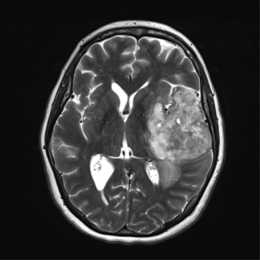 File:Cerebral metastasis mimicking glioblastoma (Radiopaedia 69155-78937 Axial T2 21).png
