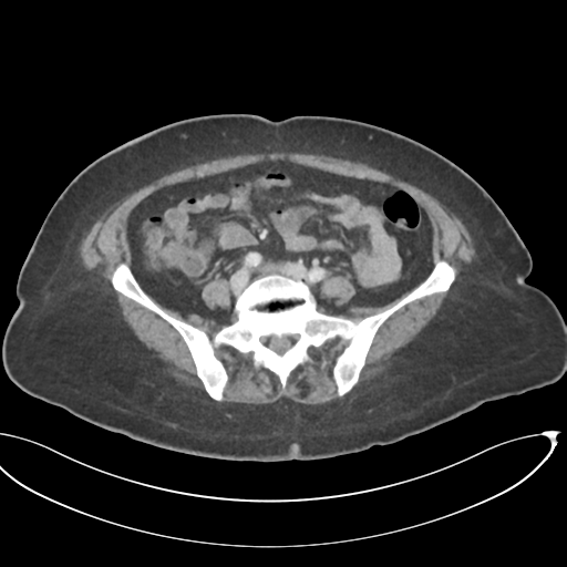 File:Cerebral metastasis to basal ganglia (Radiopaedia 81568-95414 E 52).png