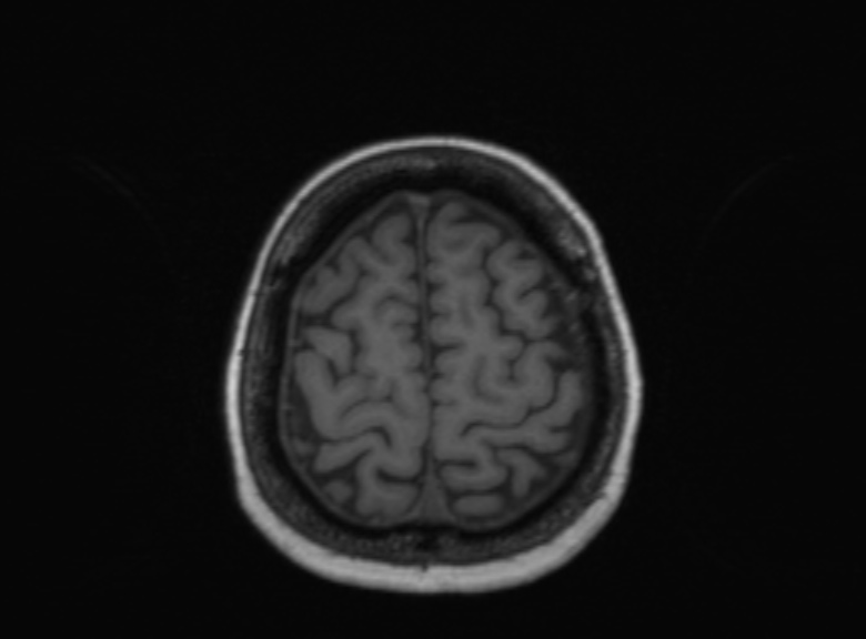 Cerebral ring enhancing lesions - cerebral metastases (Radiopaedia 44922-48817 Axial T1 131).jpg