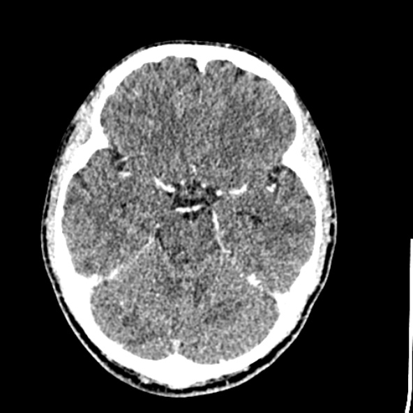 Cerebral toxoplasmosis (Radiopaedia 53993-60131 Axial C+ delayed 27).jpg