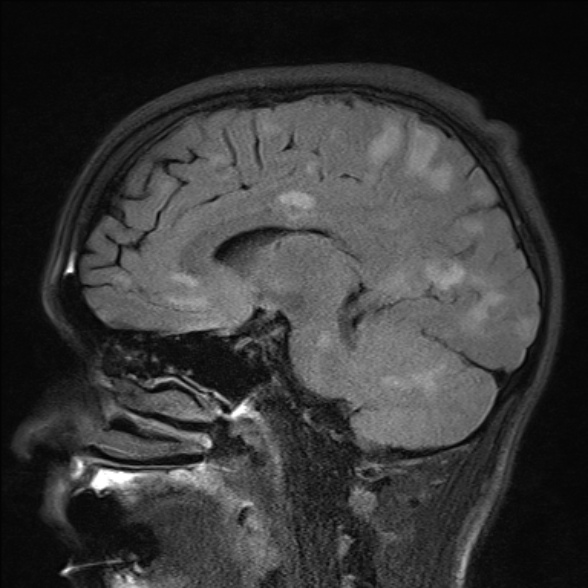 File:Cerebral toxoplasmosis (Radiopaedia 53993-60132 Sagittal FLAIR 16).jpg
