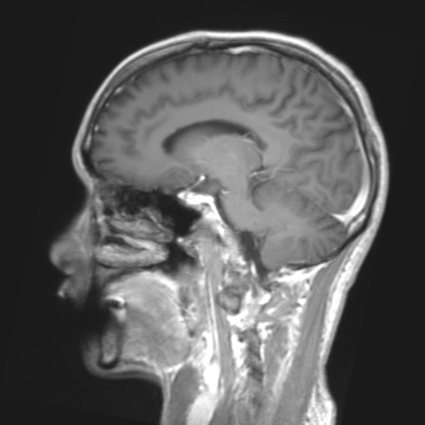 File:Cerebral toxoplasmosis (Radiopaedia 53993-61435 Coronal T1 20).jpg