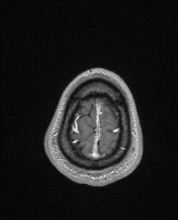 Cerebral toxoplasmosis (Radiopaedia 85779-101597 Axial T1 C+ 149).jpg