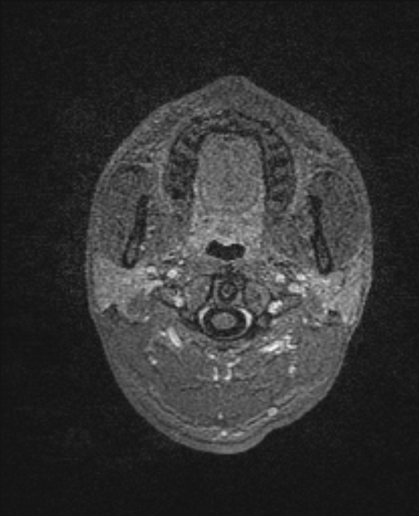 Cerebral toxoplasmosis (Radiopaedia 85779-101597 Axial T1 C+ 2).jpg