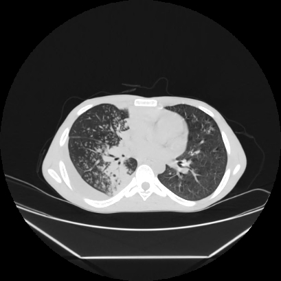 Cerebral tuberculoma (Radiopaedia 80829-94318 Axial lung window 92).jpg