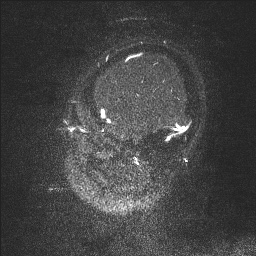 Cerebral tuberculosis with dural sinus invasion (Radiopaedia 60353-68090 Sagittal MRV 137).jpg