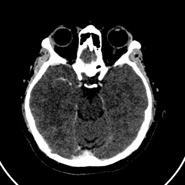File:Cerebral venous hemorrhagic infarct from venous sinus thrombosis (Radiopaedia 55433-61883 Axial C+ delayed 96).jpg