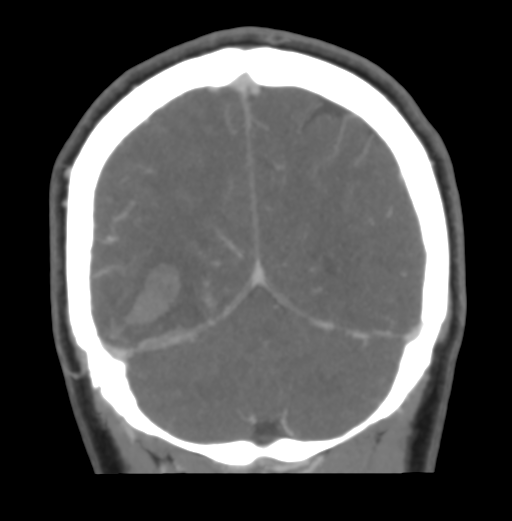 Cerebral venous hemorrhagic infarction (Radiopaedia 38461-40550 Coronal MIP VENOGRAM 46).png