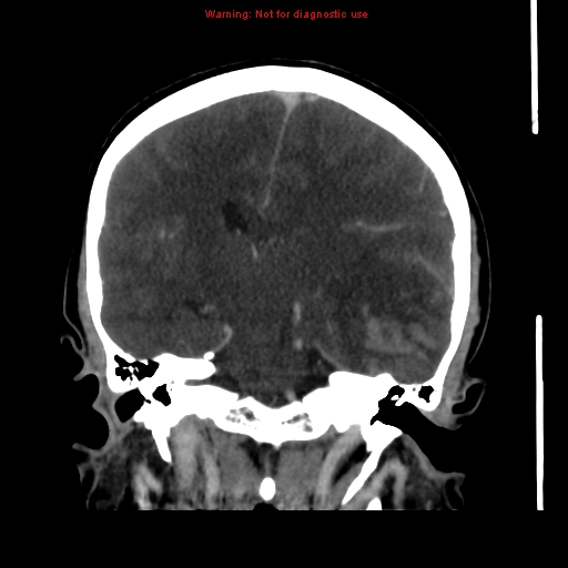 Cerebral venous infarction (Radiopaedia 12404-20735 B 45).jpg
