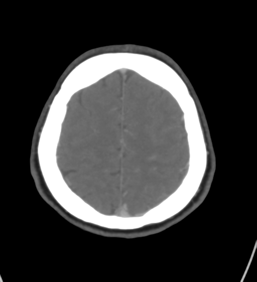 Cerebral venous infarction due to transverse sinus thrombosis (Radiopaedia 34688-36120 Axial CT venogram 41).png