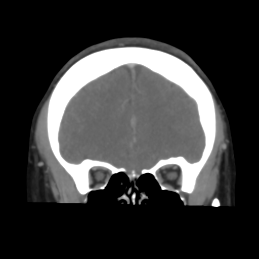 File:Cerebral venous infarction due to transverse sinus thrombosis (Radiopaedia 34688-36120 Coronal 19).png