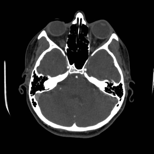 Cerebral venous sinus thrombosis (Radiopaedia 40619-43227 A 62).jpg