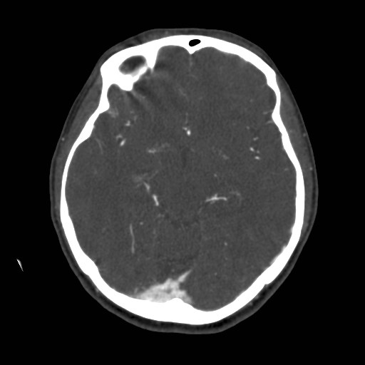 Cerebral venous sinus thrombosis (Radiopaedia 40619-43227 A 96).jpg
