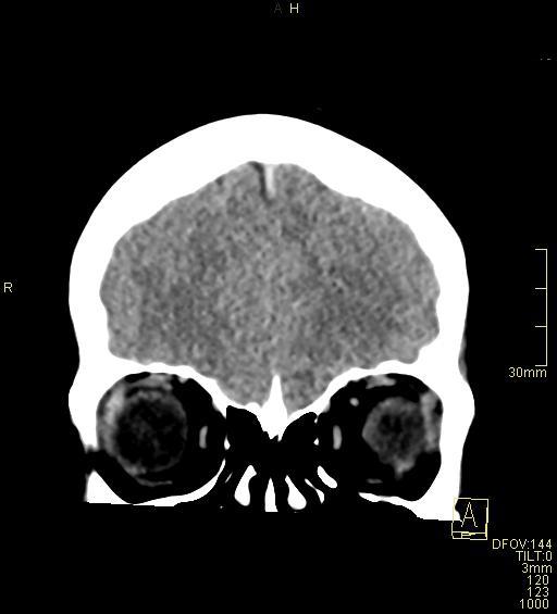 Cerebral venous sinus thrombosis (Radiopaedia 91329-108965 Coronal non-contrast 10).jpg