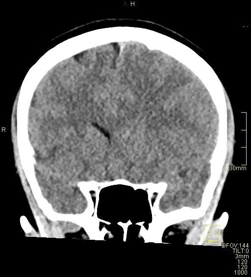 File:Cerebral venous sinus thrombosis (Radiopaedia 91329-108965 Coronal non-contrast 20).jpg