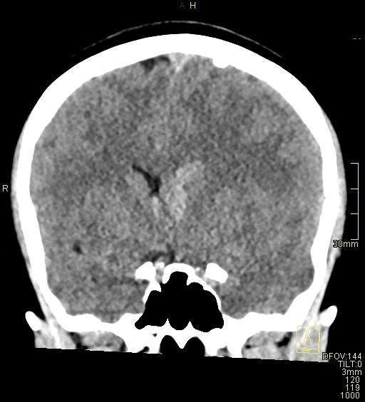 Cerebral venous sinus thrombosis (Radiopaedia 91329-108965 Coronal non-contrast 23).jpg