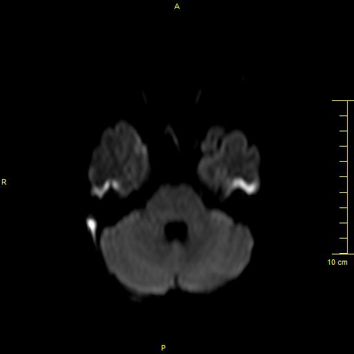 File:Cerebral venous thrombosis (Radiopaedia 23288-23351 Axial DWI 9).JPG