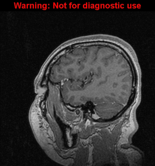 Cerebral venous thrombosis (Radiopaedia 37224-39208 Sagittal T1 C+ 119).jpg