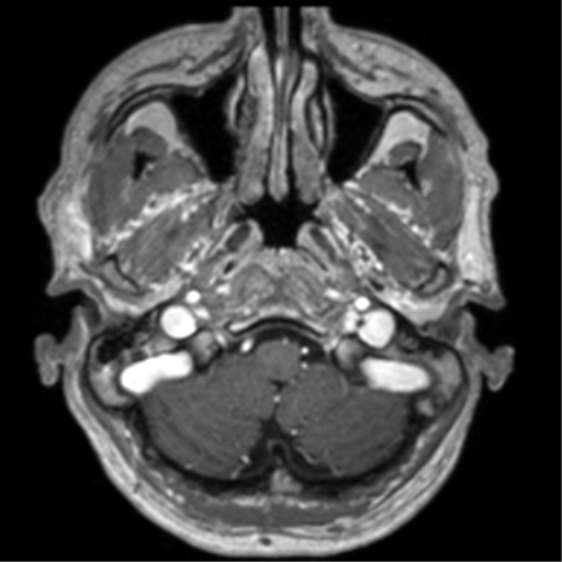 Cerebral venous thrombosis (Radiopaedia 38392-40469 Axial T1 C+ 13).png