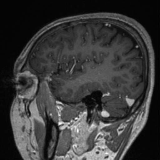 Cerebral venous thrombosis (Radiopaedia 38392-40469 Sagittal T1 C+ 24).png