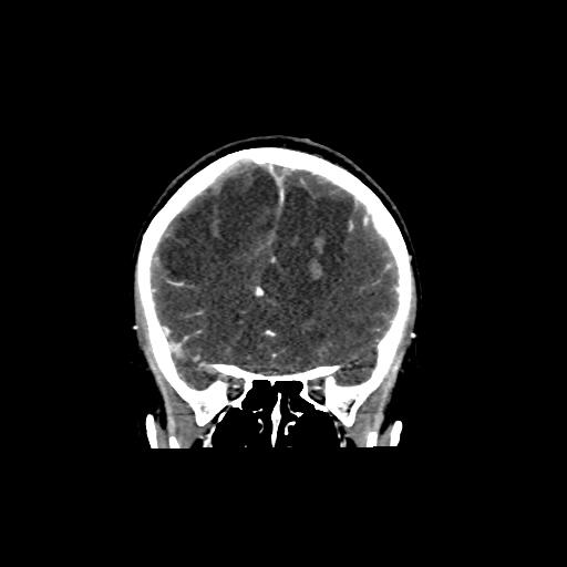File:Cerebral venous thrombosis - hemorrhagic venous infarction (Radiopaedia 87318-103613 Coronal 29).jpg
