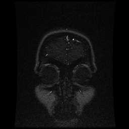 Cerebral venous thrombosis - ulcerative colitis (Radiopaedia 66049-75219 Coronal MRV 106).jpg