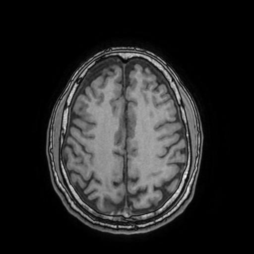 File:Cerebral venous thrombosis with secondary intracranial hypertension (Radiopaedia 89842-106957 Axial T1 126).jpg